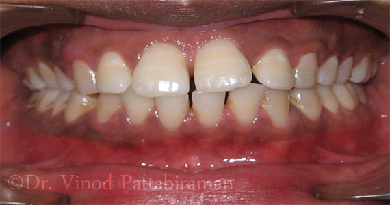 Before the Treatment of Invisible/Lingual braces
